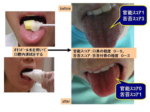 オキシドールで口腔ケアを行うと舌苔が取れ、口臭が改善する比較写真