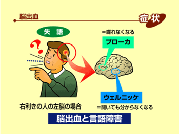 脳の病気の話03