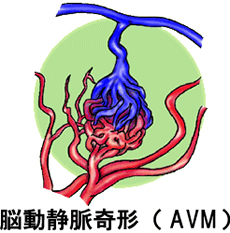 脳動静脈奇形（ＡＶＭ）