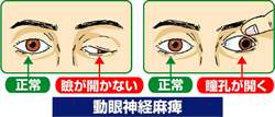 動眼神経麻痺