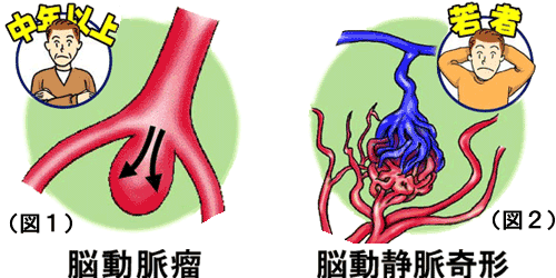 （図１）脳動脈瘤 (図２)脳動静脈奇形