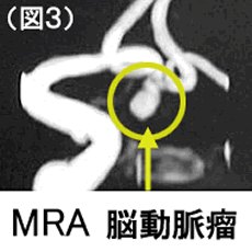 ＭＲＡ 脳動脈瘤