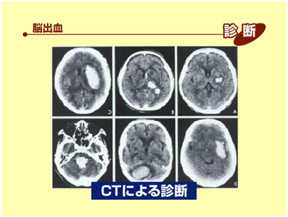 CTによる診断