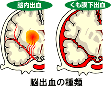 脳出血の種類