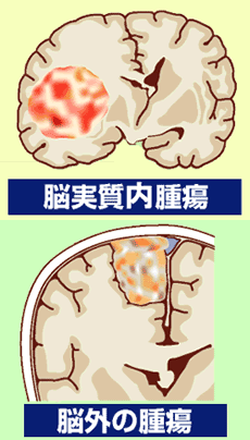 脳実質内腫瘍 脳外の腫瘍