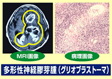 多形性神経膠芽腫（グリオブラストーマ）