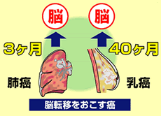 脳転移をおこす癌