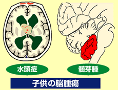 子供の脳腫瘍