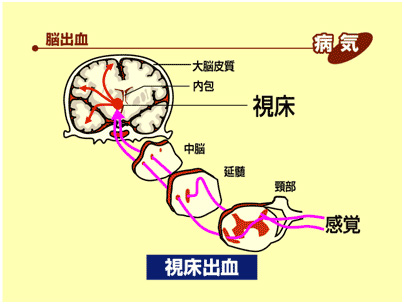 視床出血