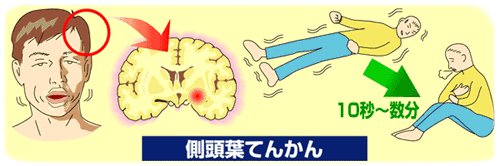 てんかん 発作 症状