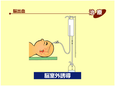 脳室外誘導