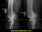 第12回　膝蓋骨高位症、変形性膝関節症 -足が長い人の悩み-