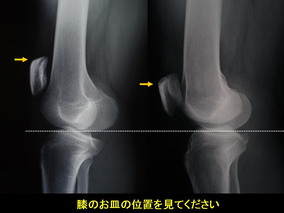 知って得する身体の話 第12回 膝蓋骨高位症 変形性膝関節症 足が長い人の悩み 鶴巻温泉病院 神奈川県