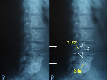 知って得する身体の話 第8回 筋筋膜性腰痛 ぎっくり腰 腰椎分離症 鶴巻温泉病院 神奈川県