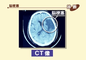 脳梗塞CT画像