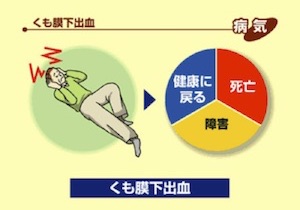 くも膜下出血